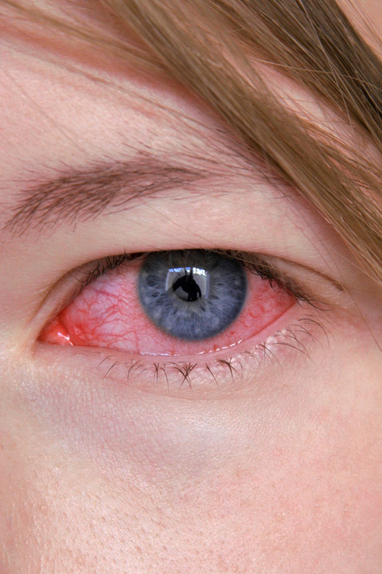 pink eye treatment antibiotic